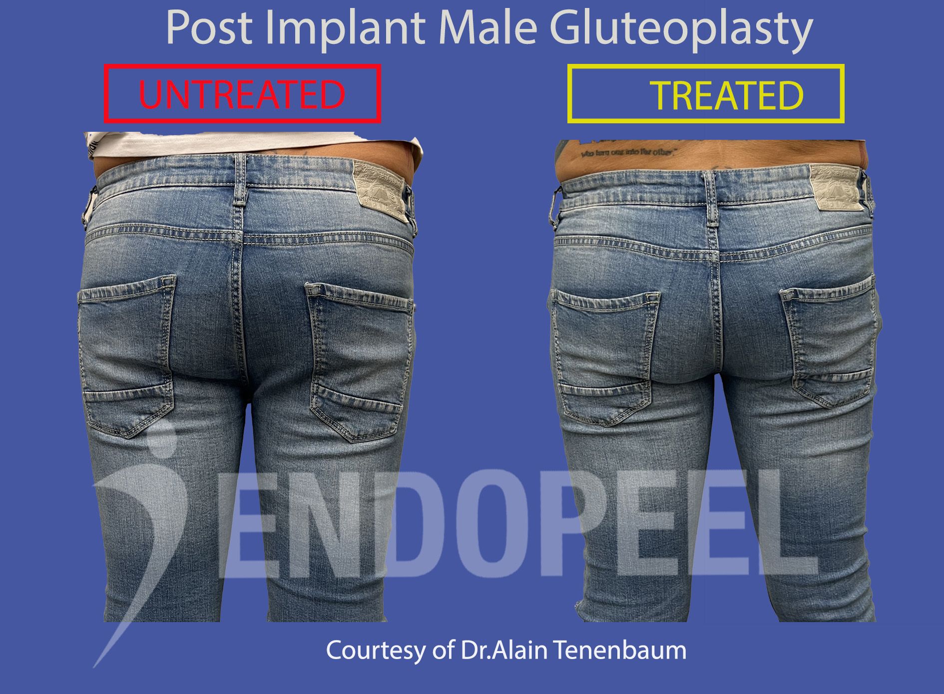 endopeel-gluteoplasty-post-male-implants
