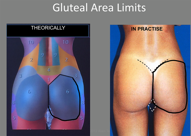 endopeel gluteal area limits in practise