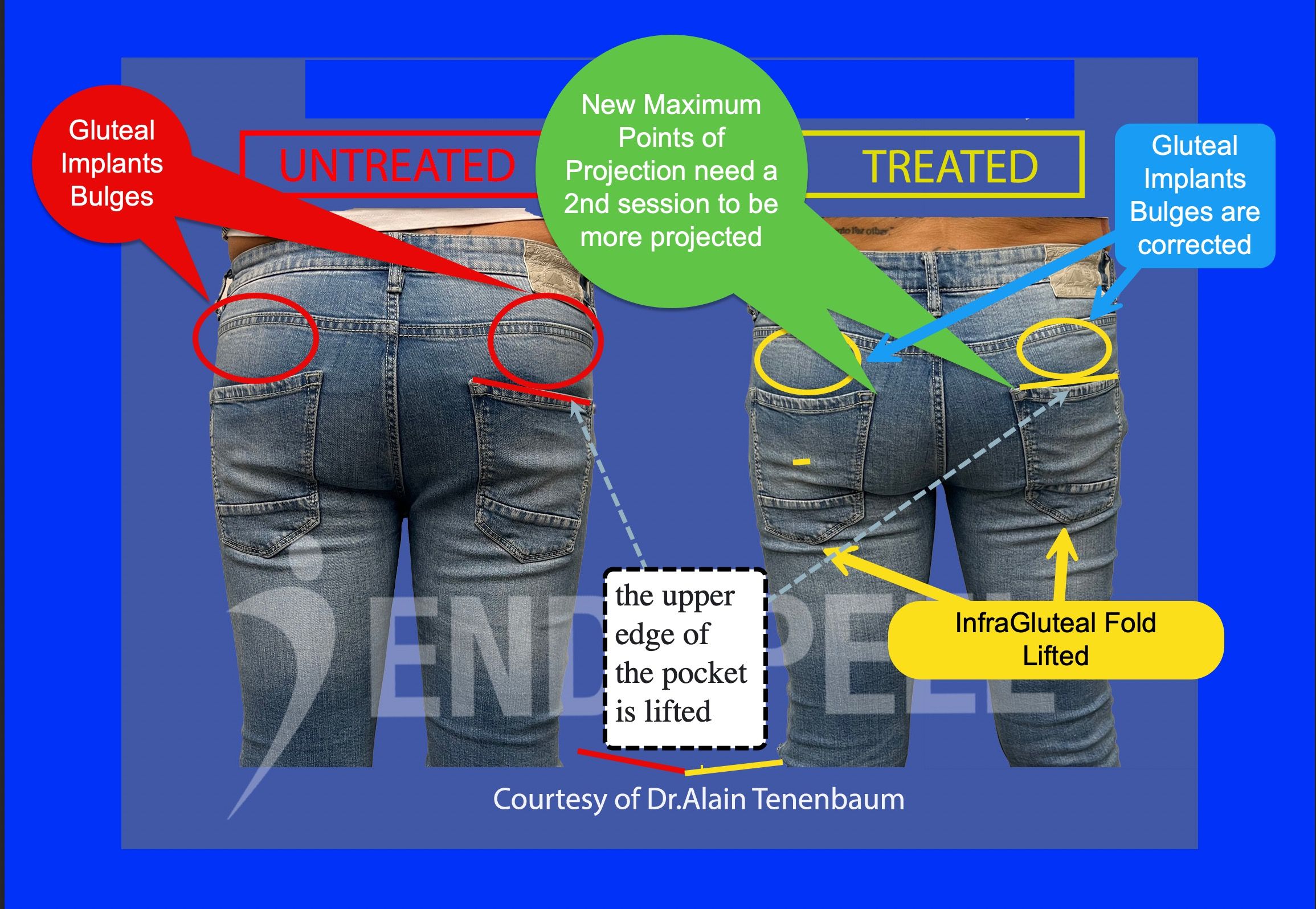 between-1st-and-2nd-session-post-male-gluteal-implants.jpg