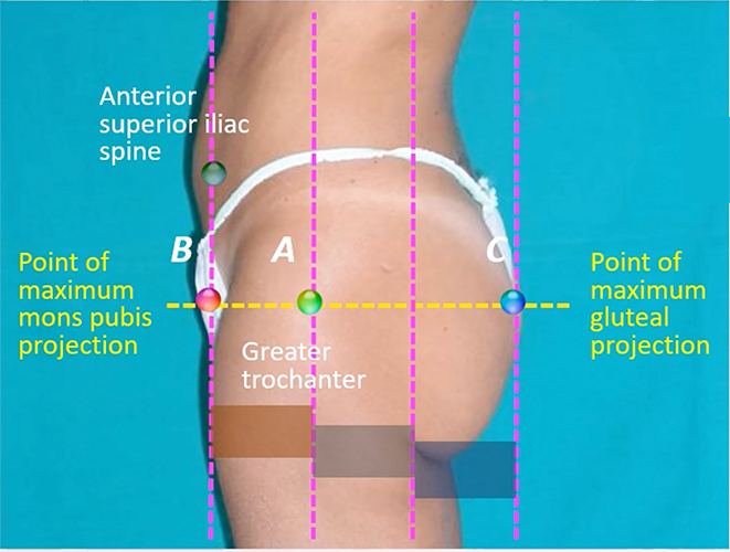 old determination of maximum gluteal projection