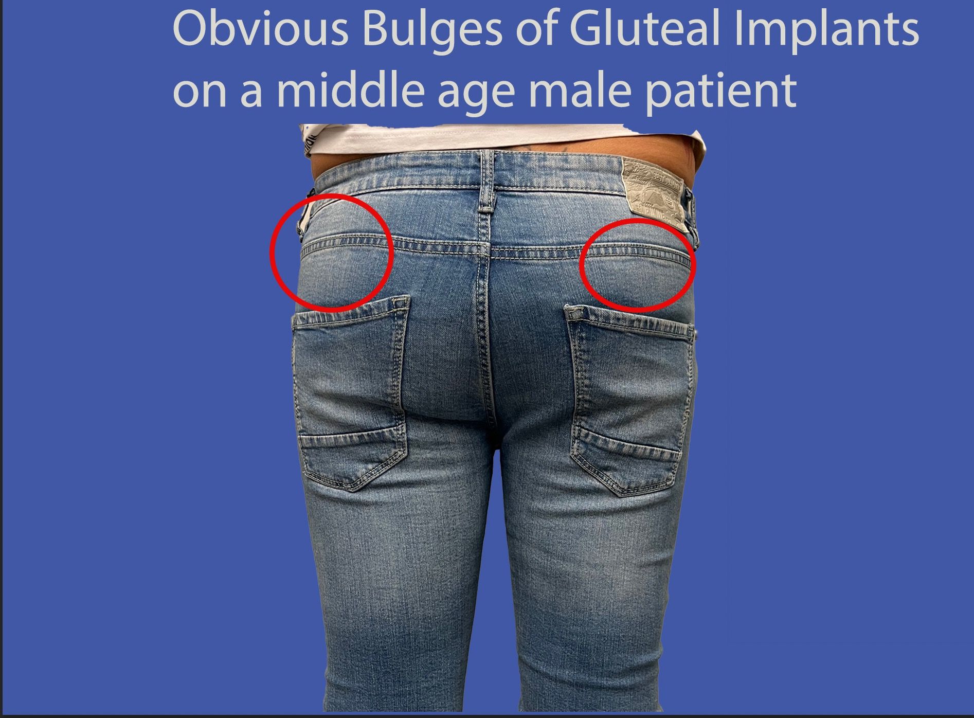 obvious-bluges-gluteal-male-implants