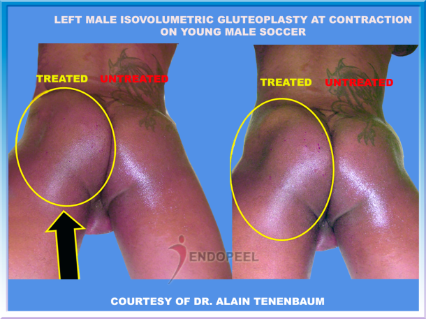 left male soccer gluteoplasty at contraction