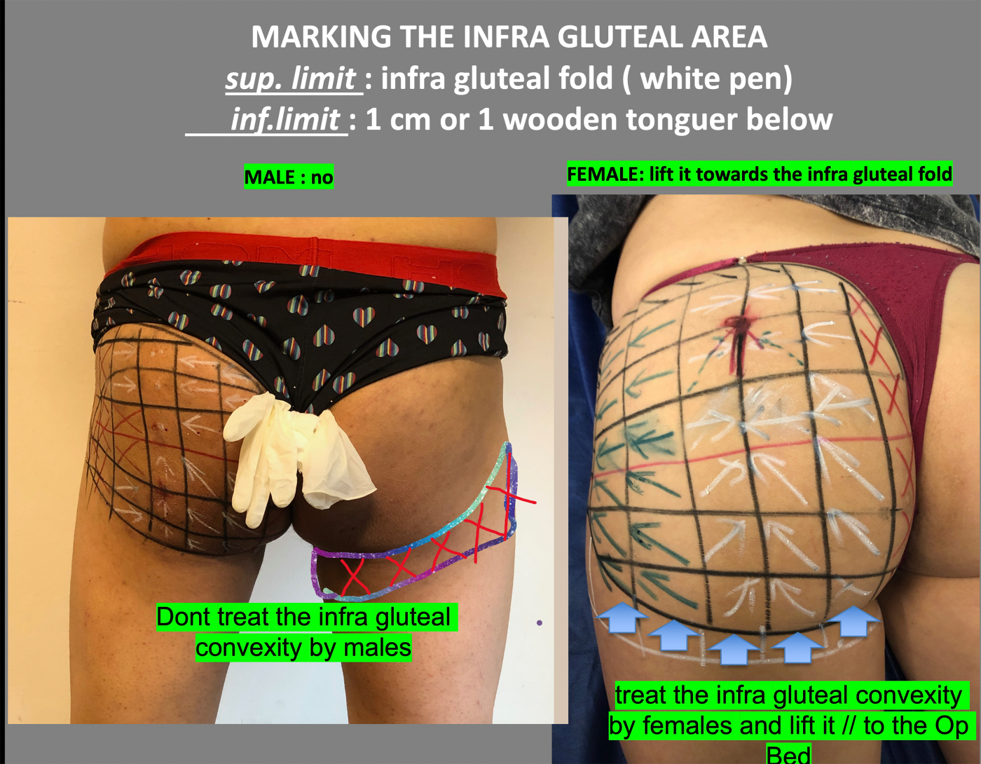 marking the infra gluteal area